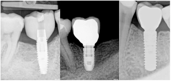 Nazik yumşaq toxumada platform switching xüsusiyyətli implantlarda sümük itkisi