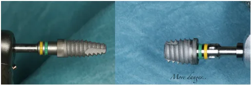 Qısa implantda krestal sümük itkisinin osseointeqrasiya sahəsinə təsiri