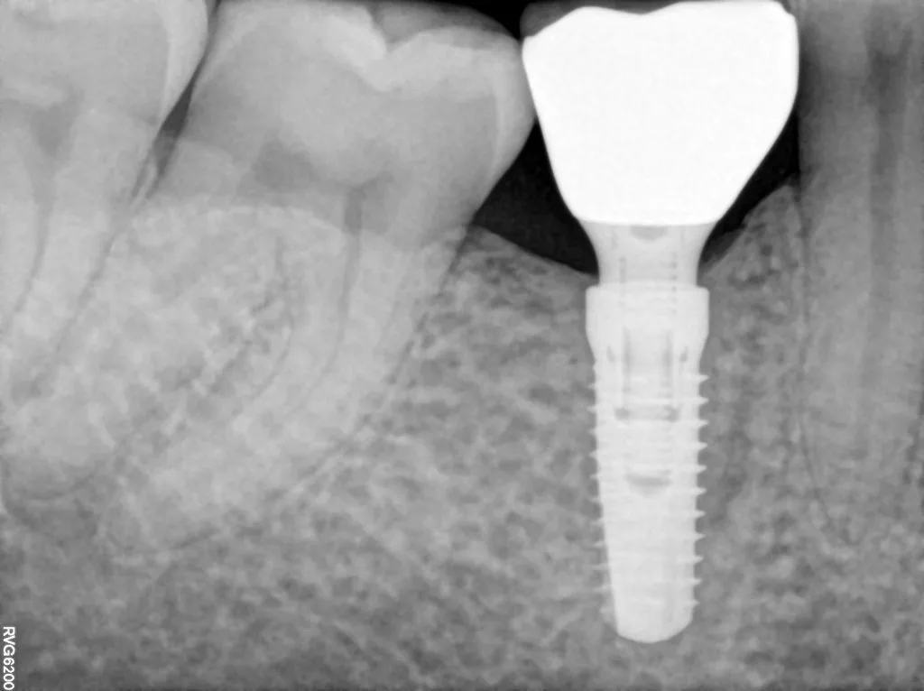 İllər sonra da sabit qalmış marginal sümük səviyyəsi olan implant
