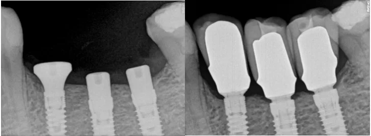 Subkrestal yerləşdirilmiş implant və nəzarətli sümük remodelasiyası