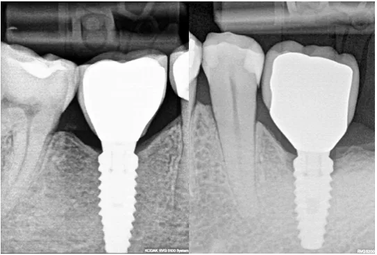 Sümük itkisi olmayan (A) və krestal sümük itkisi olan (B) implantların müqayisəsi