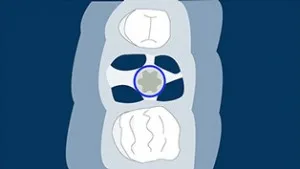 Tip A alveol — implantın koronal hissəsi tamamilə septum sümüyü içindədir