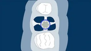 Tip B alveol — implant stabildir, lakin septum onu tam əhatə etmir