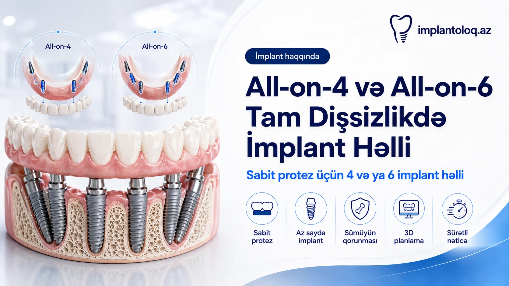 All-on-4 və All-on-6 — tam dişsizlikdə implant həlli