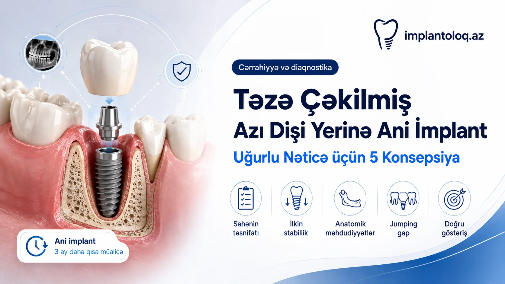 Təzə çəkilmiş azı dişi yerinə ani implant — 5 konsepsiya