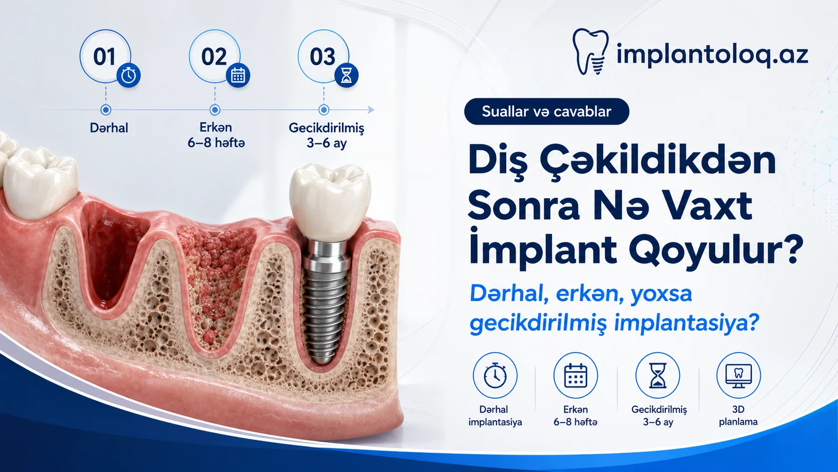 Diş çəkildikdən sonra nə vaxt implant qoyulur
