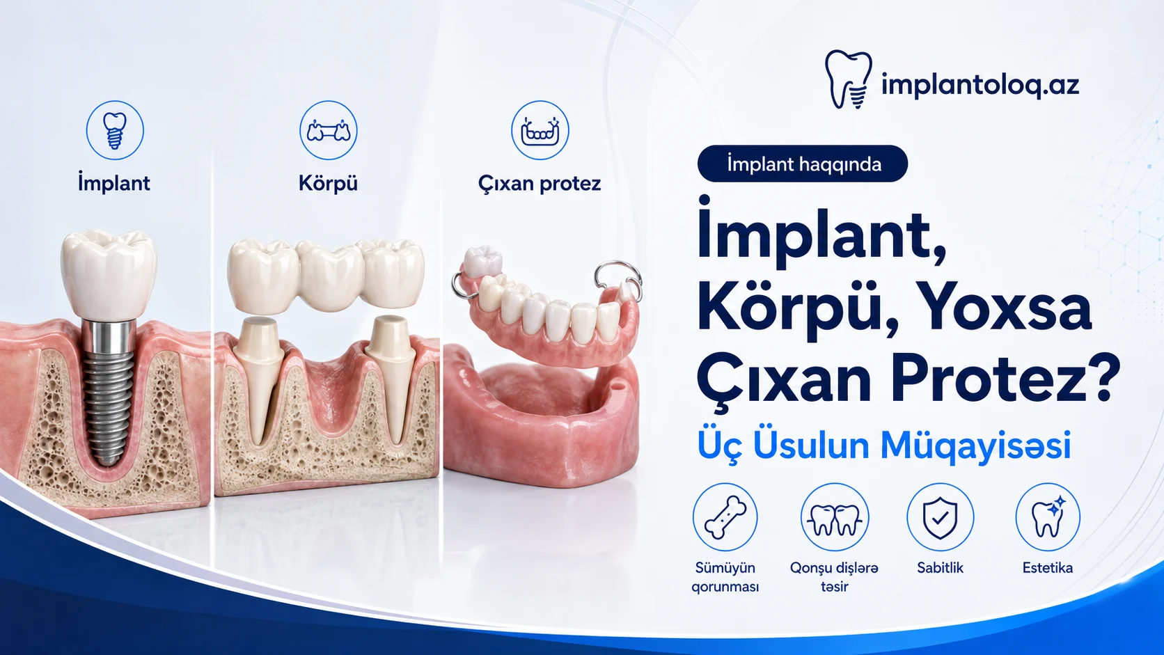 İmplant, körpü, yoxsa çıxan protez — üç üsulun müqayisəsi