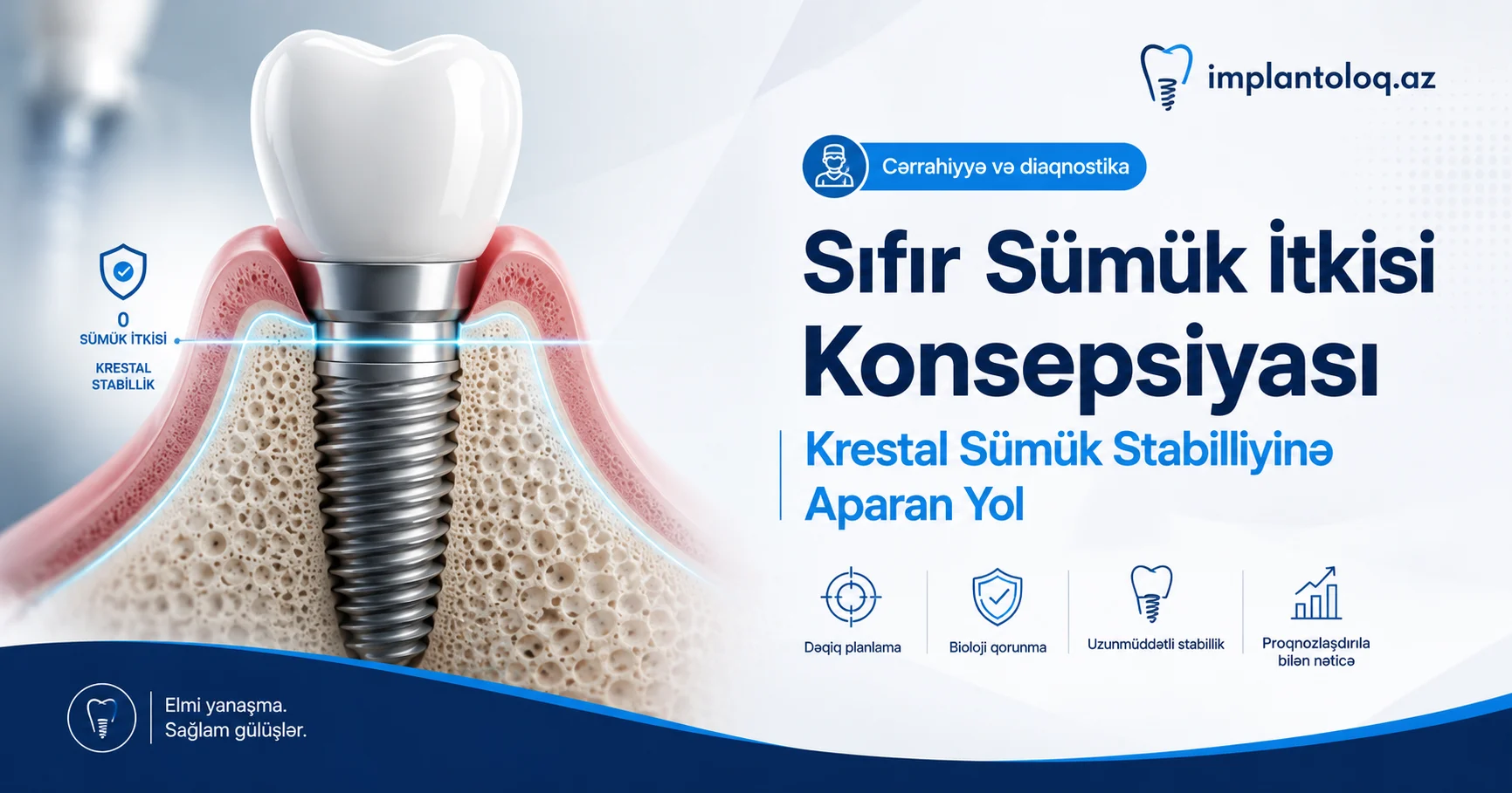 Sıfır sümük itkisi konsepsiyası — krestal sümük stabilliyi