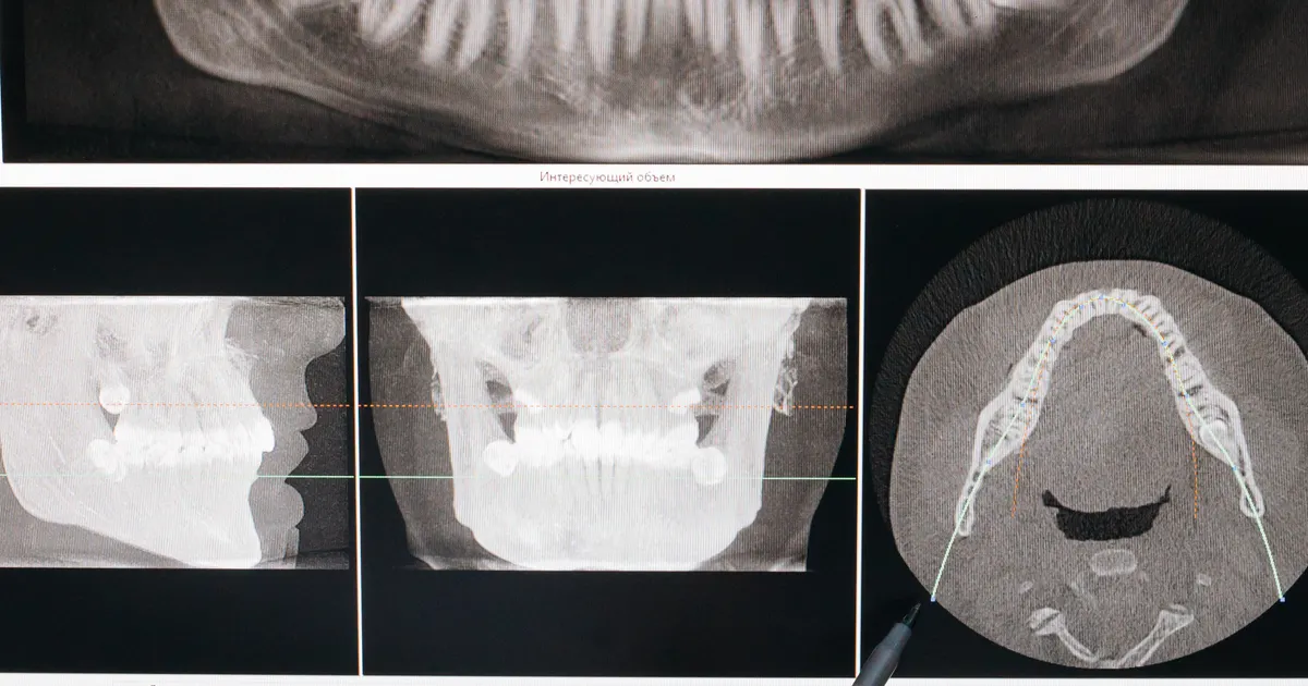 Diş həkimi kompüterdə 3D görüntünü təhlil edir