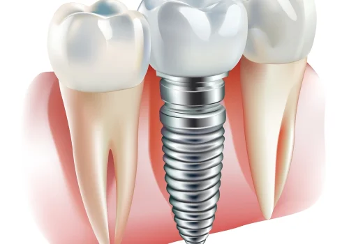 Dis implanti nedir? Implantoloq izah edir