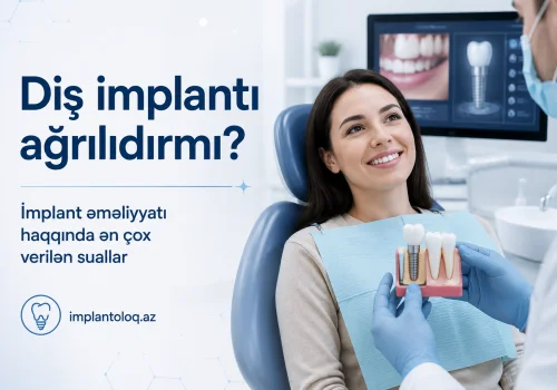 Dis Implanti Agrilidirmi? Implant Emeliyyati Haqqinda En Cox Verilen Suallar