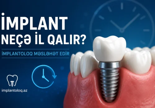 Implant Nece Il Qalir? Implantoloq Meslehet Edir