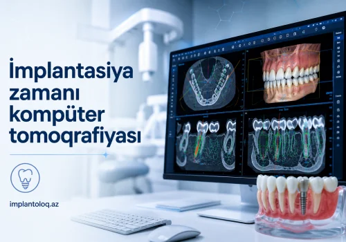 Implantasiya Zamani Komputer Tomoqrafiyasinin (KT) Ehemiyyeti: Niye 3D Diaqnostika?