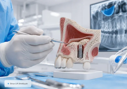Sinus-Lift Emeliyyati: