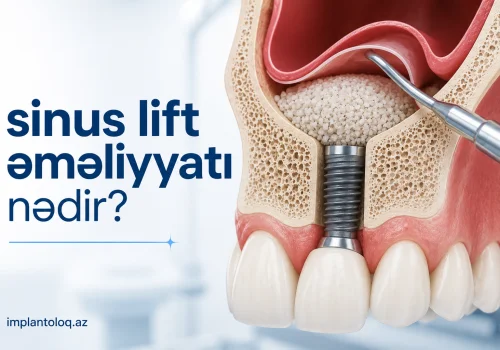 Ust Cenede Sumuk Catismazligi: Sinus Lift Emeliyyati Nedir?